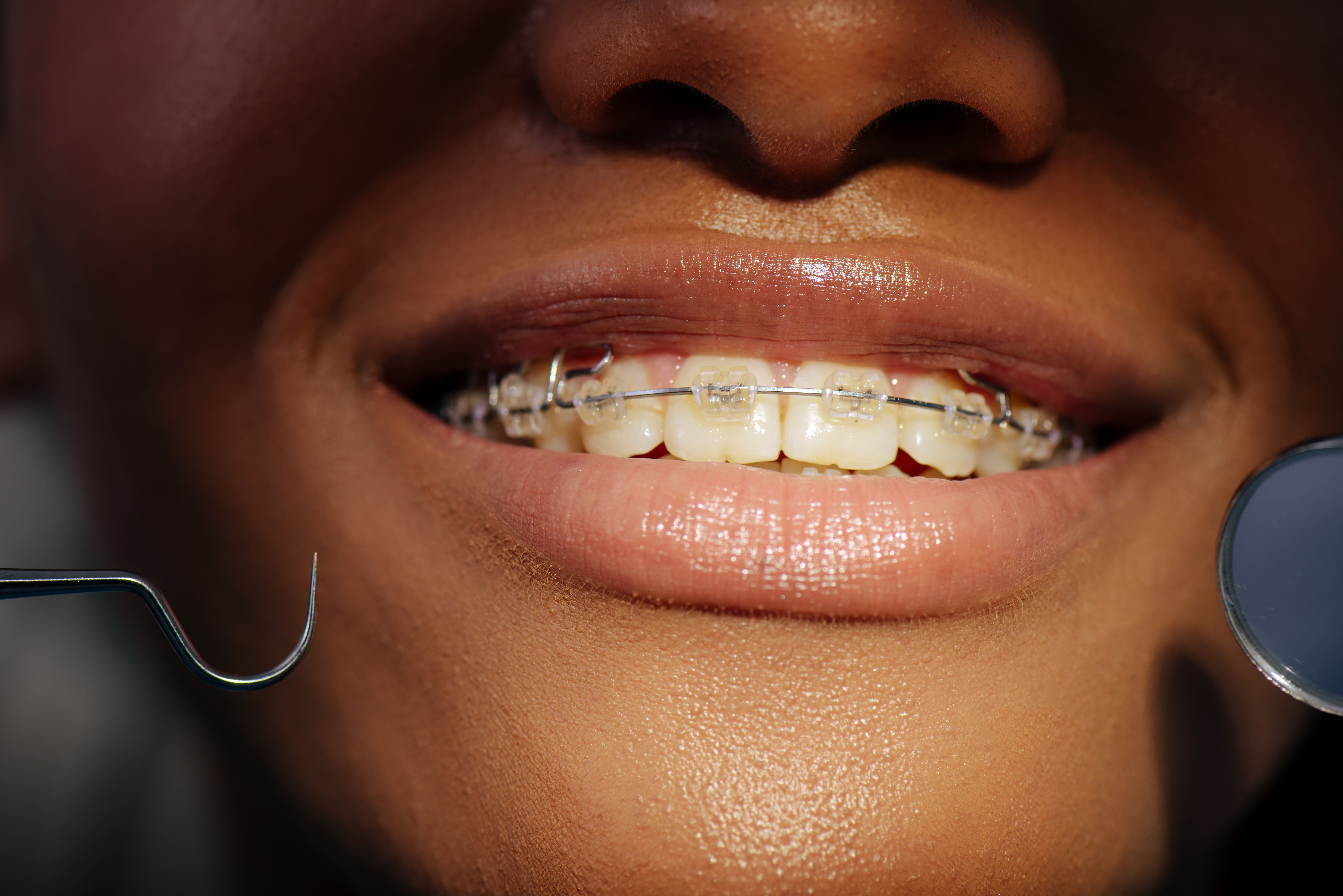close_up_of_happy_woman_in_braces