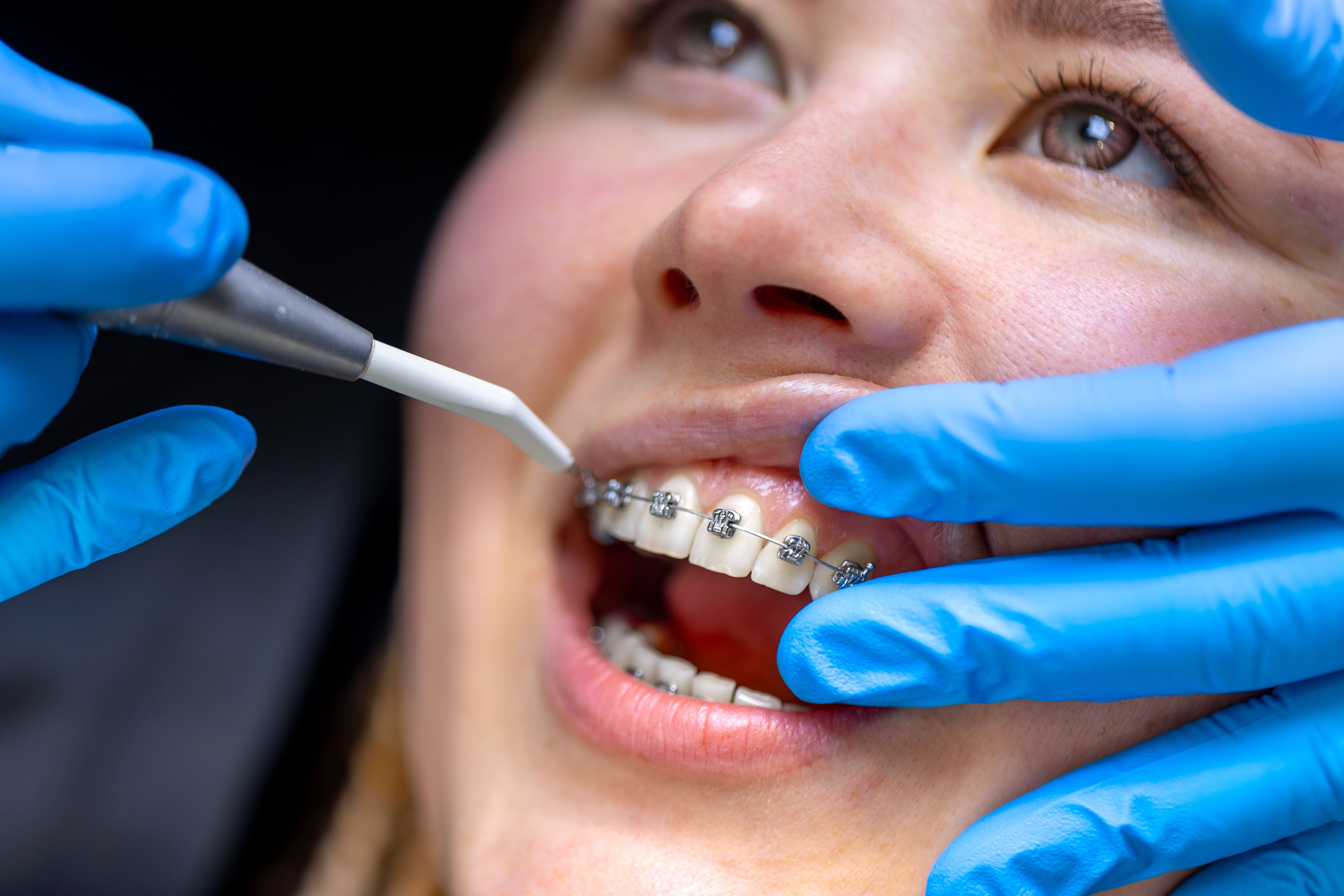how-long-does-orthodontic-treatment-take-for-adults