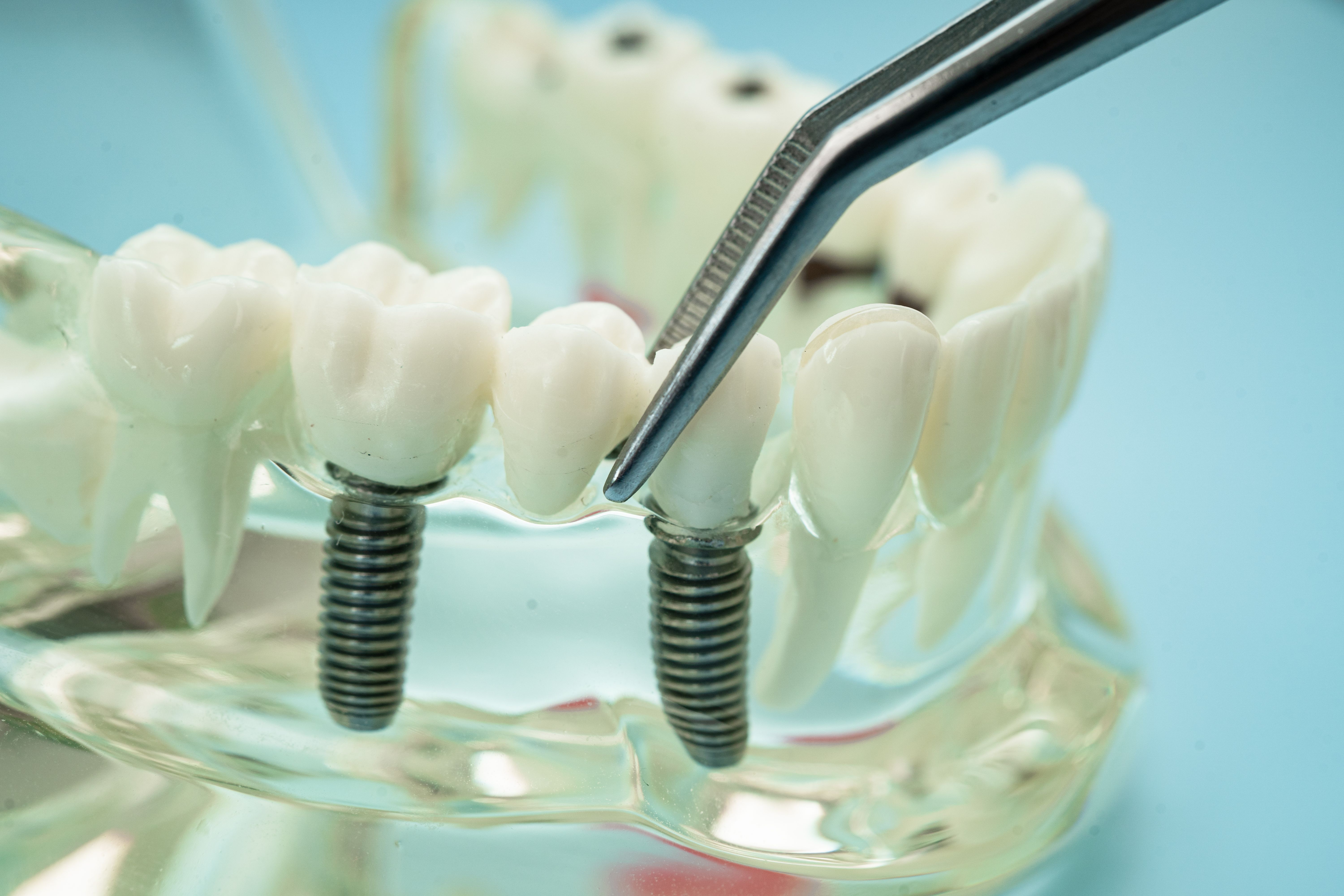 single-tooth-implant-vs-dental-bridge-which-replacement-is-better