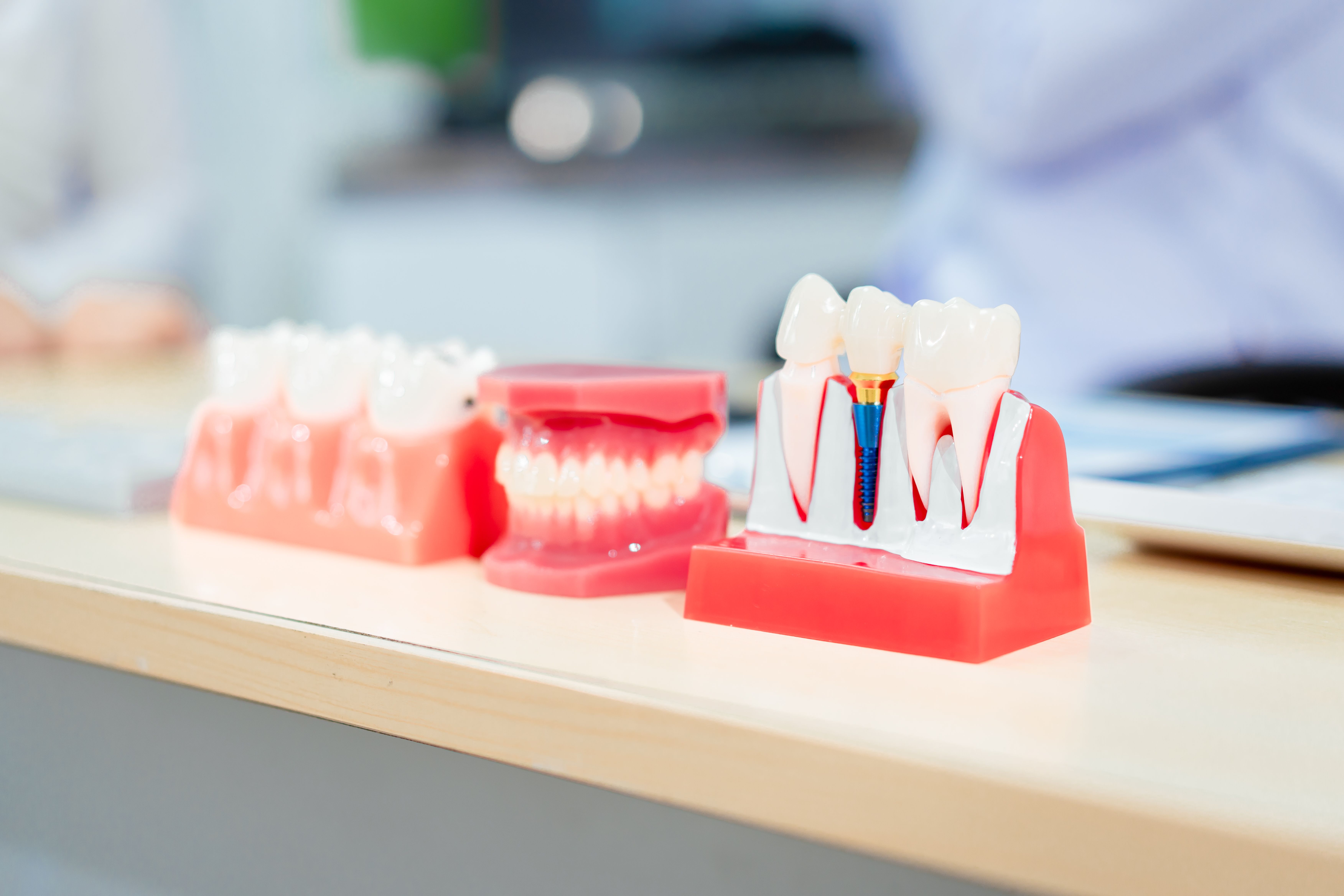 dental-implant-surgery-recovery-timeline-and-tips-for-a-smooth-healing-1