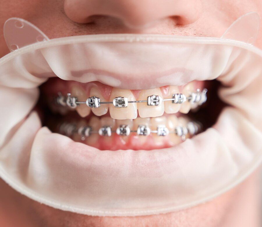 male-patient-with-cofferdam-mouth-showing-teeth-with-braces 651396-3439