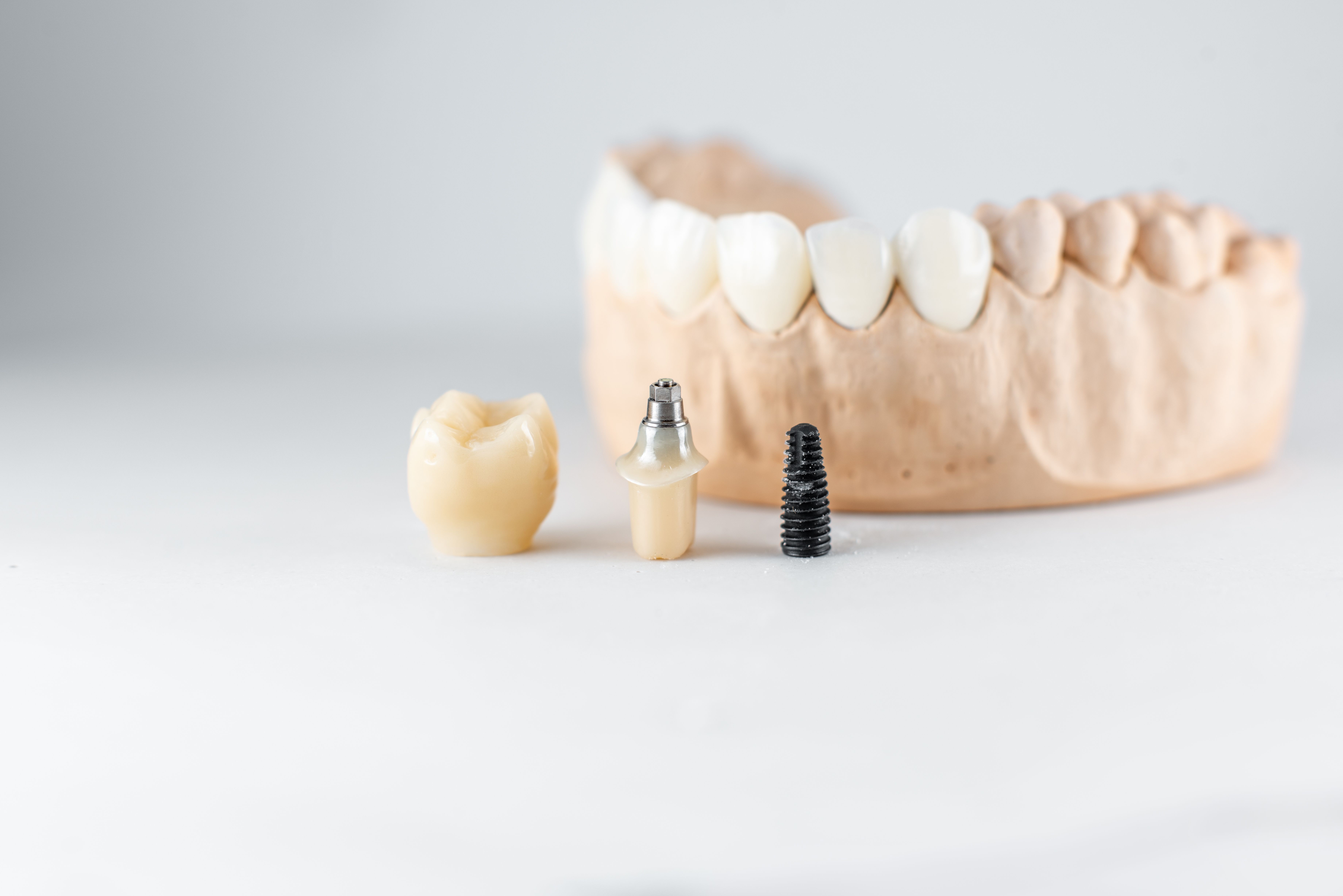 all-on-4-dental-implants-procedure-step-by-step-guide