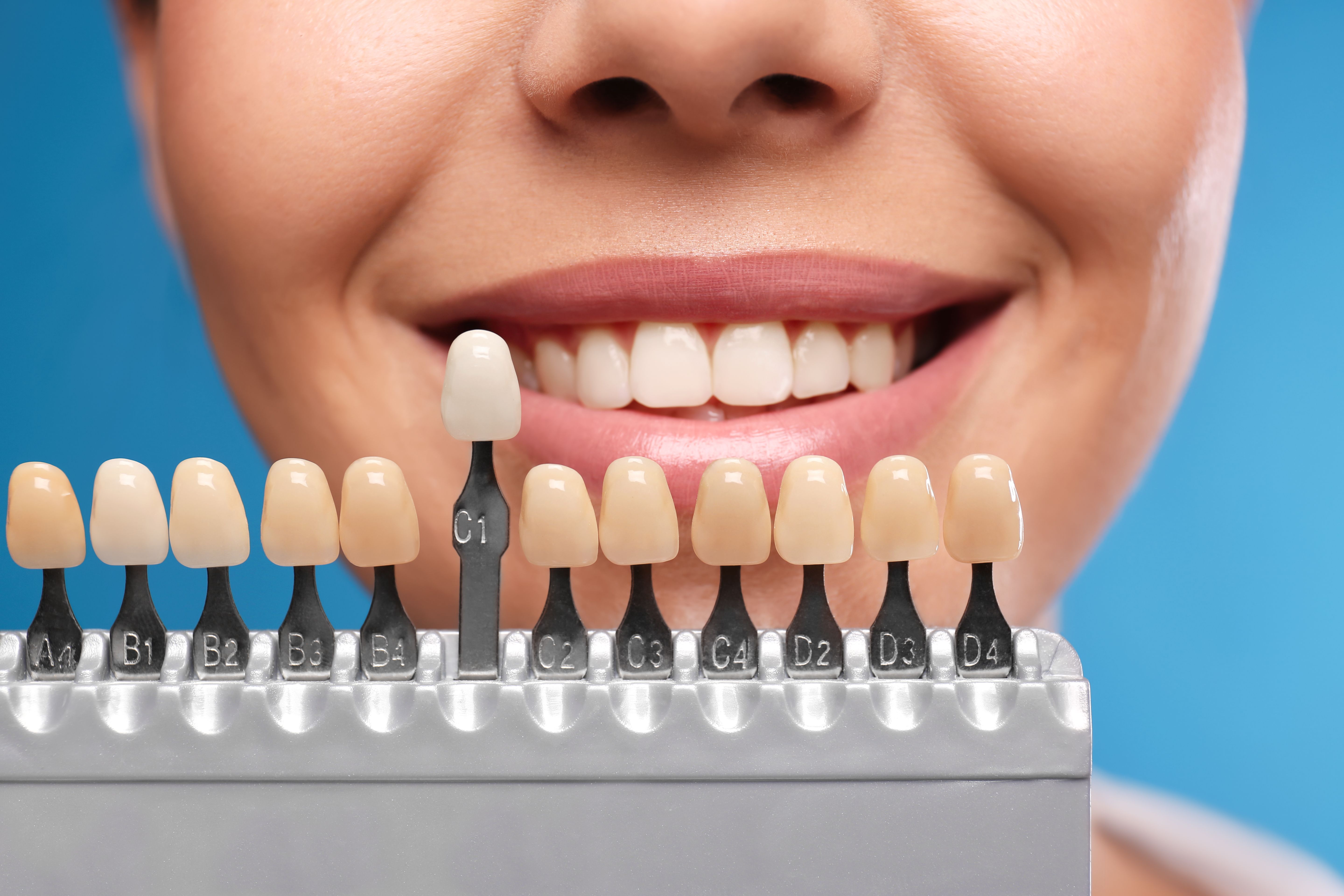 Porcelain Veneers vs Composite Veneers: Which Should You Choose? main image || ''